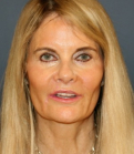 Feel Beautiful - Facelift 100 - After Photo